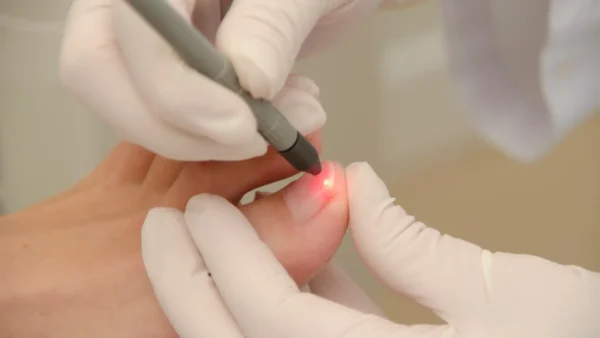 dra sindy sanchez medicina estetica y cosmetologia Laser CO2 para una enterrada