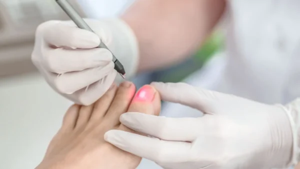 dra sindy sanchez medicina estetica y cosmetologia Laser para hongos en unas