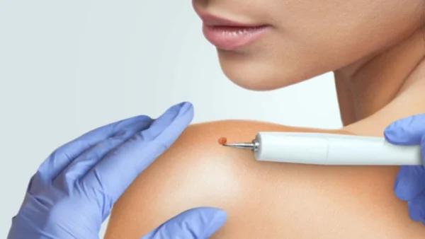 dra sindy sanchez medicina estetica y cosmetologia Tratamiento laser CO2 para verrugas del cuello fibromas blandos